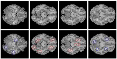 Benchmarking the influence of pre-training on explanation performance in MR image classification